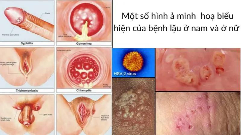 điều trị bệnh lậu bao lâu thì khỏi