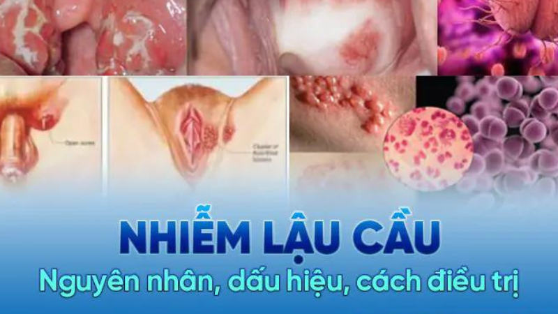 bệnh lậu bao lâu thì phát hiện