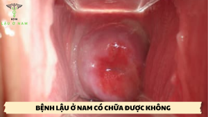 bệnh lậu ở nam có chữa được không