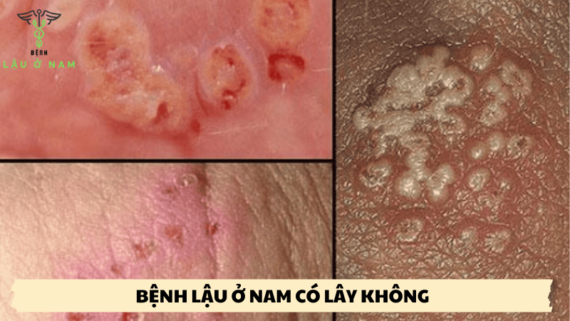 bệnh lậu ở nam có lây không