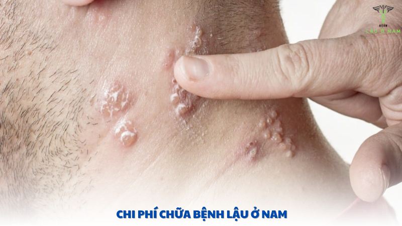 chi phí chữa bệnh lậu ở nam