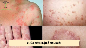 chữa bệnh lậu ở nam giới